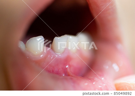 搖晃的孩子的門牙(乳牙) 搖晃的孩子的門牙(乳牙) 85049892