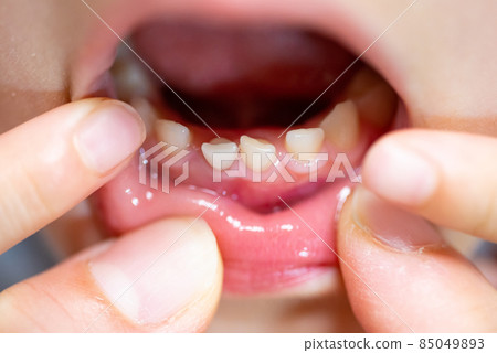 搖晃的孩子的門牙(乳牙) 搖晃的孩子的門牙(乳牙) 85049893