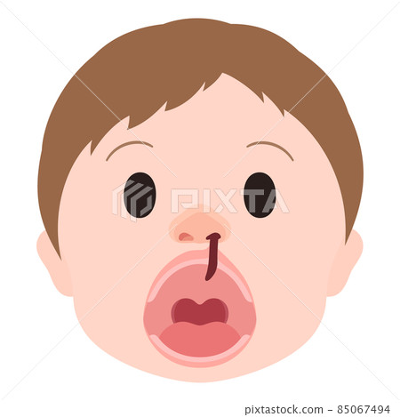 唇裂和腭裂的插圖_單側唇裂和腭裂_面部_開口 85067494