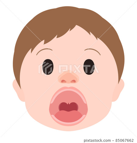 唇裂和腭裂的插圖_懸雍垂_面部_開口 唇裂和腭裂的插圖_懸雍垂_面部_開口 85067662