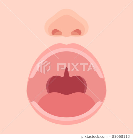 Illustration of cleft lip and palate_soft palate_up Illustration of cleft lip and palate_soft palate_up 85068113