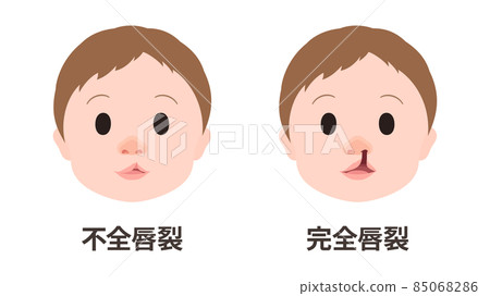 唇裂和腭裂_缺陷和完全裂唇_面的插圖 唇裂和腭裂_缺陷和完全裂唇_面的插圖 85068286