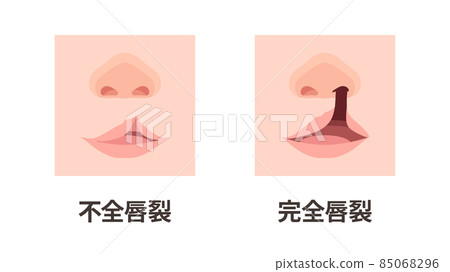 唇裂和腭裂_不完全和完全裂唇的圖示_up 唇裂和腭裂_不完全和完全裂唇的圖示_up 85068296