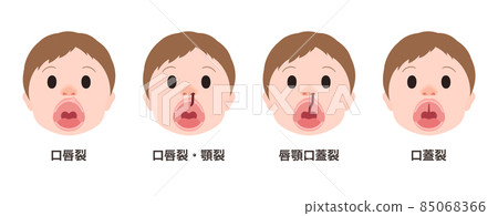 開封時的唇裂、腭裂、腭裂示意圖 開封時的唇裂、腭裂、腭裂示意圖 85068366