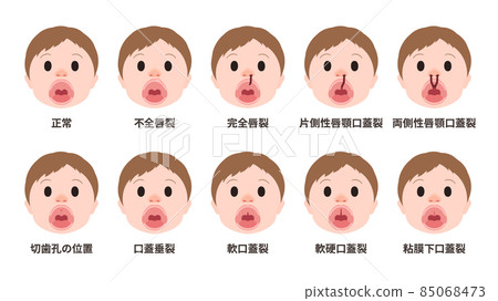 唇齶裂類型的插圖 唇齶裂類型的插圖 85068473