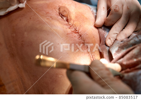 Surgeons team working with patient. breast augmentation 85083517