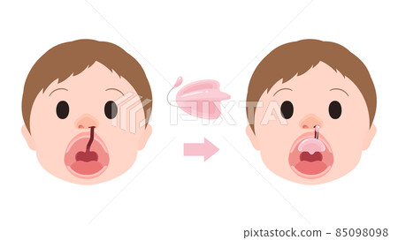 Cleft lip and palate_Hots Floor wearing illustration_Hotz Floor_NAM available 85098098