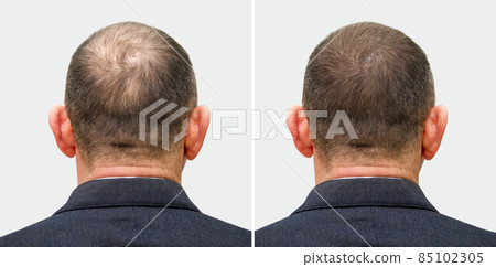 The head of a balding man before and after hair transplant surgery. A man losing his hair has become shaggy. An advertising poster for a hair transplant clinic. Treatment of baldness. 85102305