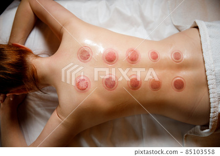 A young woman relaxes in a massage parlor. Vacuum cups of medical cupping therapy on woman back, close up, chinese medicine. 85103558