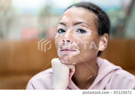 Black african american woman with vitiligo pigmentation skin problem indoor dressed pink hoodie 85120072