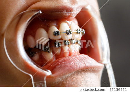 A young woman with metal braces is being examined by an orthodontist. Correction of the bite of teeth in the dental clinic. Concept of healthy teeth. 85136351