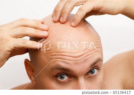 The head of a balding man. A bald man was upset because of the hair loss. Treatment of baldness. The head of a balding man. A bald man was upset because of the hair loss. Treatment of baldness. 85136417