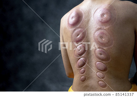 Man after cupping treatment on the back Man after cupping treatment on the back 85141337