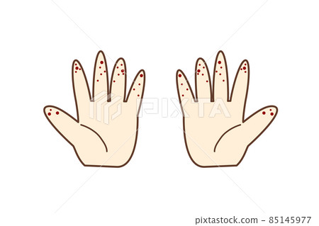 Illustration material: Fingertips of hand with hand-foot-and-mouth disease 85145977