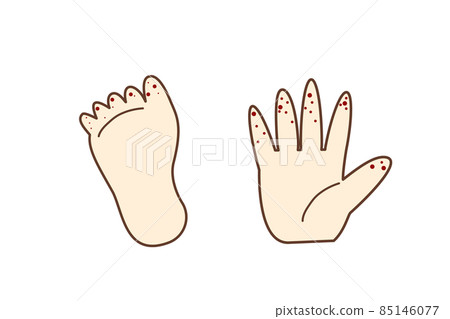 Illustration material: Fingers and toes of hand-foot-and-mouth disease 85146077
