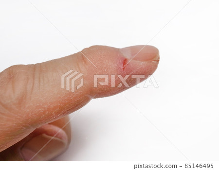 Nail crevices 85146495
