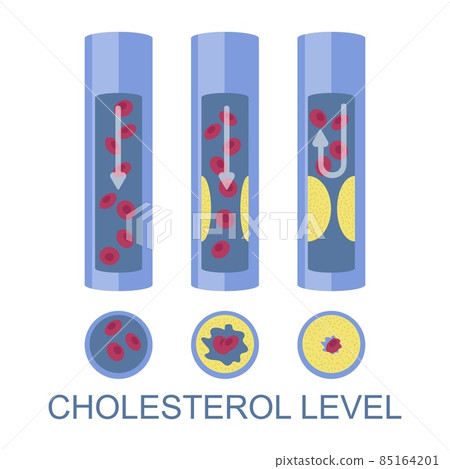 Low, normal, high cholesterol level, vector illustration. High ldl risk factor for heart disease, atherosclerosis. 85164201
