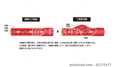 健康主動脈與主動脈夾層對比圖（附評論） 85175477