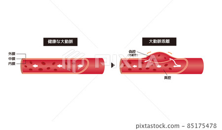 Comparison illustration of healthy aorta and aortic dissection Comparison illustration of healthy aorta and aortic dissection 85175478