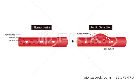 健康主動脈與主動脈夾層對比圖 健康主動脈與主動脈夾層對比圖 85175479