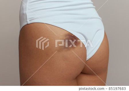 Hematoma and Large Bruise, blood under skin Congestion. Hematoma and Large Bruise, blood under skin Congestion. 85197683