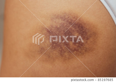 Hematoma and Large Bruise, blood under skin Congestion. 85197685