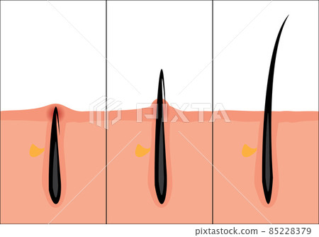 Normal and ingrown hair vector illustration. Skincare problem. Normal and ingrown hair vector illustration. Skincare problem. 85228379