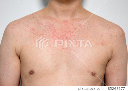 Dermatitis rash viral disease with immunodeficiency on body of young adult asian, scratch with itch Dermatitis rash viral disease with immunodeficiency on body of young adult asian, scratch with itch 85268677