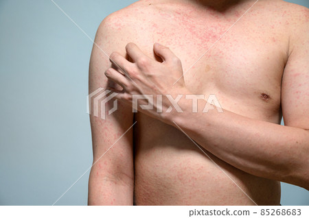 Dermatitis rash viral disease with immunodeficiency on body of young adult asian, scratching with itching 85268683