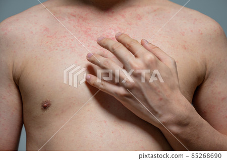 Dermatitis rash viral disease with immunodeficiency on body of young adult asian, scratching with itching 85268690