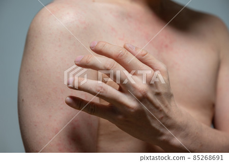 Dermatitis rash viral disease with immunodeficiency on body of young adult asian, scratching with itching 85268691