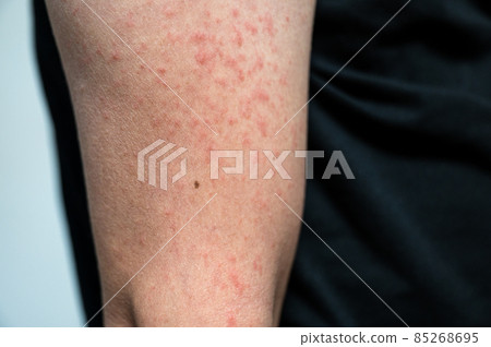 Dermatitis rash viral disease with immunodeficiency on body of young adult  asian, scratch with itch Stock Photo