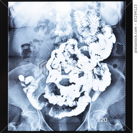 Barium study of small bowel after two hours 85294123