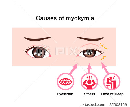 眼瞼 miokimia（眼瞼抽搐）的原因矢量圖 85308139
