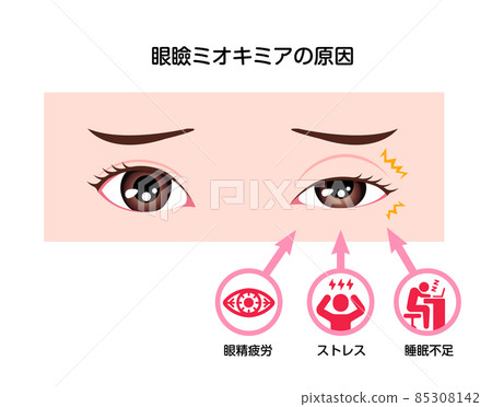 Cause vector illustration of eyelid miokimia (eyelid jerks) 85308142