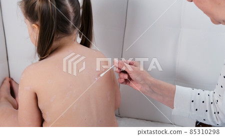 Female being treated with chickenpox rash on little girl's body with atiseptic cream at home. The Female being treated with chickenpox rash on little girl's body with atiseptic cream at home. The 85310298