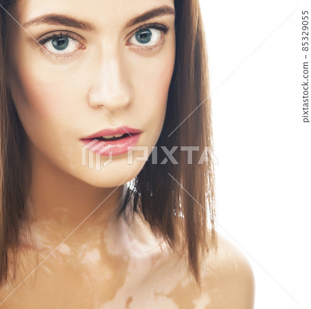 beautiful young brunette woman with vitiligo disease close up isolated on white beautiful young brunette woman with vitiligo disease close up isolated on white 85329055