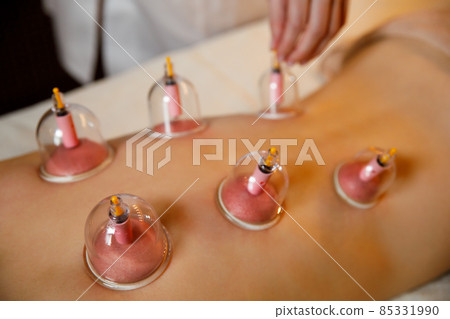 A young woman relaxes in a massage parlor. Vacuum cups of medical cupping therapy on woman back, close up, chinese medicine. A young woman relaxes in a massage parlor. Vacuum cups of medical cupping therapy on woman back, close up, chinese medicine. 85331990