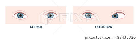 Esotropia. Horizontal strabismus before and after surgery. Eye misalignment, cross-eyed condition. Human eyes healthy and with inward gaze position Esotropia. Horizontal strabismus before and after surgery. Eye misalignment, cross-eyed condition. Human eyes healthy and with inward gaze position 85439320