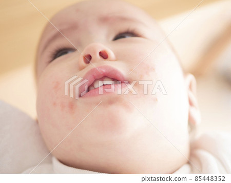 Image of eczema in the mouth of a half baby 85448352