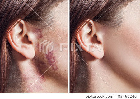 Closeup of before and after treatment woman face with real port wine stain or birthmark on face. therapy and skin laser healing. healthcare and facial care concept. 85460246