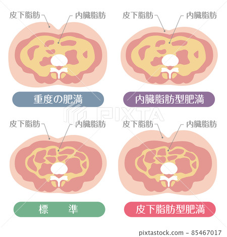 肥胖類型:皮下脂肪和內臟脂肪 肥胖類型:皮下脂肪和內臟脂肪 85467017