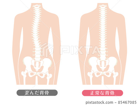 人體正常脊柱和脊柱變形 85467085