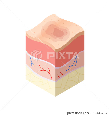 Skincare medical concept. Problems in cross-section of human skin horizontal layers structure. Anatomy illustrative model Skincare medical concept. Problems in cross-section of human skin horizontal layers structure. Anatomy illustrative model 85483287