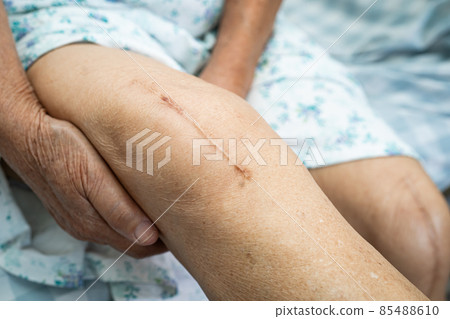 Asian senior or elderly old lady woman patient show her scars surgical total knee joint replacement Suture wound surgery arthroplasty on bed in nursing hospital ward, healthy strong medical concept. Asian senior or elderly old lady woman patient show her scars surgical total knee joint replacement Suture wound surgery arthroplasty on bed in nursing hospital ward, healthy strong medical concept. 85488610