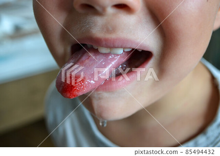 Close-up of a metal plate in the mouth on the teeth of a little boy Close-up of a metal plate in the mouth on the teeth of a little boy 85494432