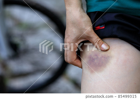 People with bruised leg casused by bike accident 85499315