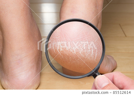 腳跟角蛋白裂縫 85512614