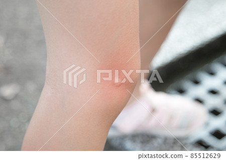 被蟲咬變紅的少女腿 被蟲咬變紅的少女腿 85512629