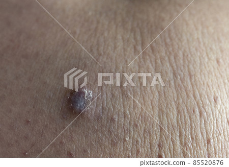 Close-up view of the an human skin with human skin sarcoma. Close-up view of the an human skin with human skin sarcoma. 85520876